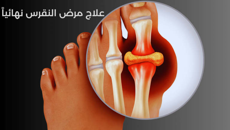علاج مرض النقرس نهائيا