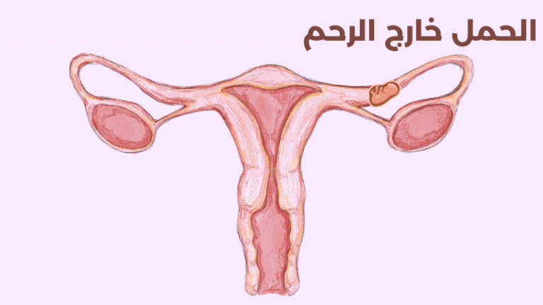 اعراض الحمل خارج الرحم